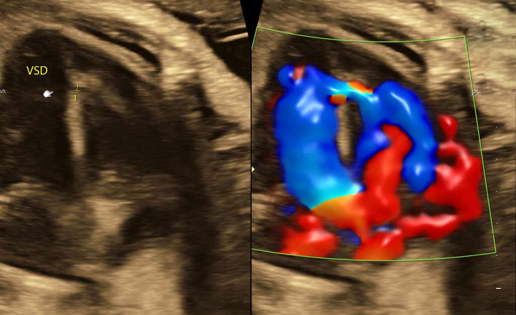 Ventrikelseptumdefekt (VSD) im Ultrschall