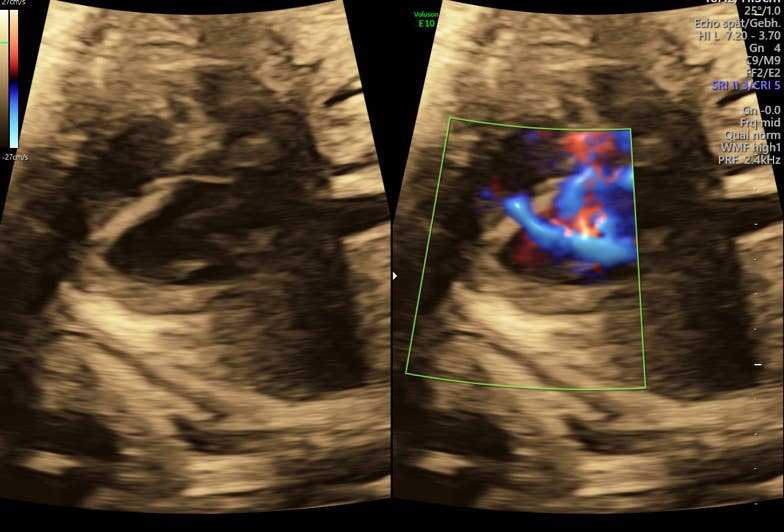 Ventrikelseptumdefekt in der 33. SSW