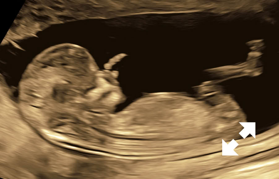 Fetus in der 13. SSW
