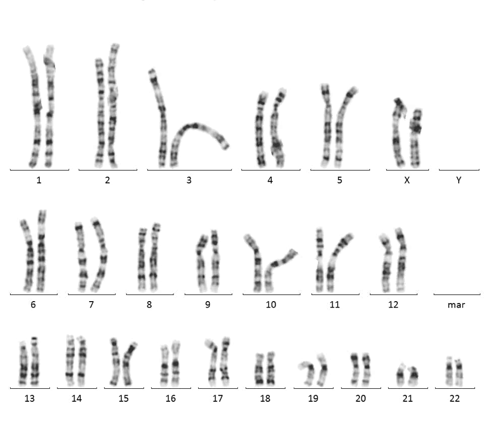 Karyogramm eines Mädchens