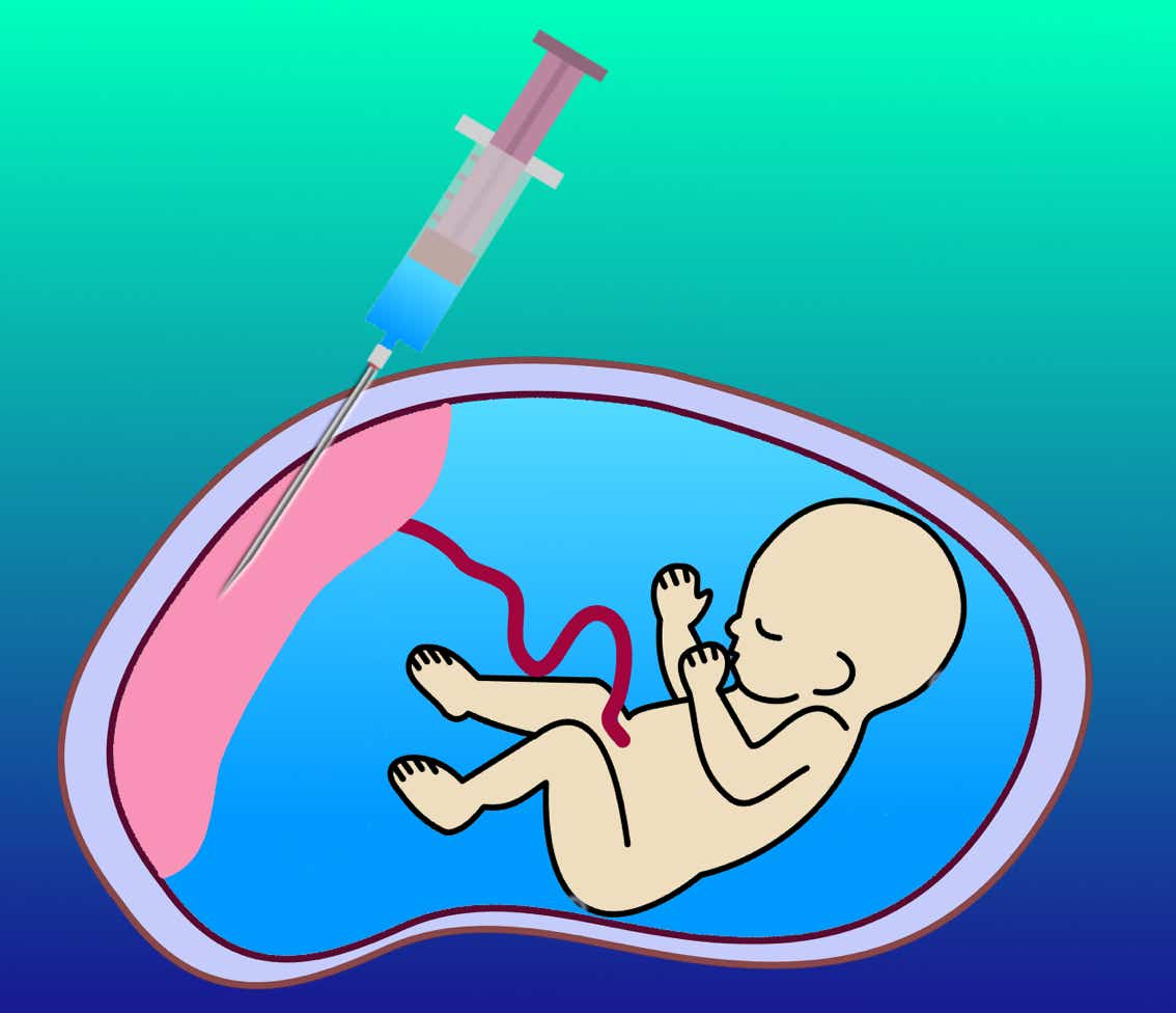 Schematische Darstellung einer Chorionzottenbiopsie