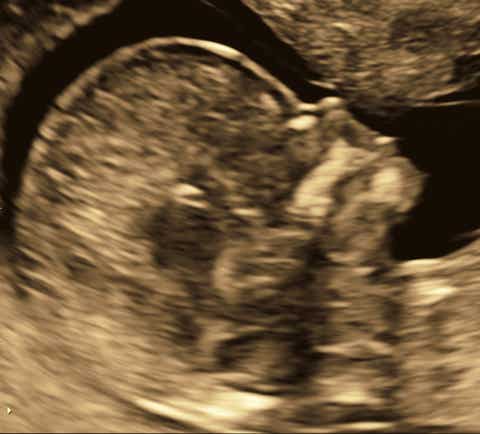 Profil mit Darstellung des fetalen Nasenbeins